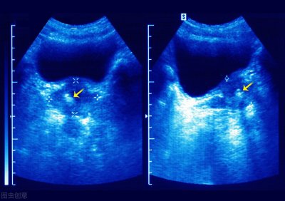 ​前列腺钙化能生育吗 B超检查发现前列腺钙化，需要治疗吗？会不会影响到生育能