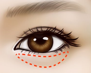 ​眼袋切除术 最详细的祛眼袋手术流程分享！姐妹们少踩坑，快学习一下