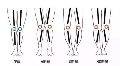 ​常见腿型不正O型腿要区分三种类型，不同类型练习方法不同