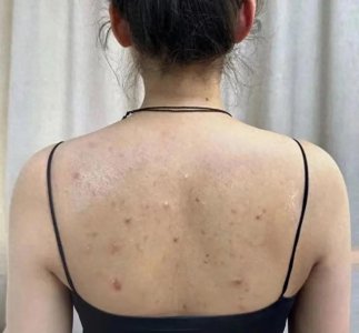 ​3招搞定螨虫痘痘！过来人百试百灵！赶紧收藏！