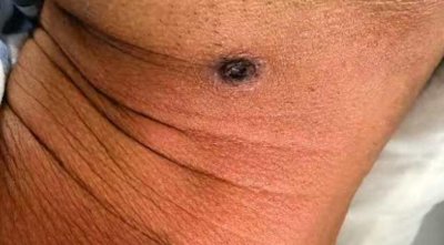 ​警惕！野外工作防恙虫，高烧焦痂是信号