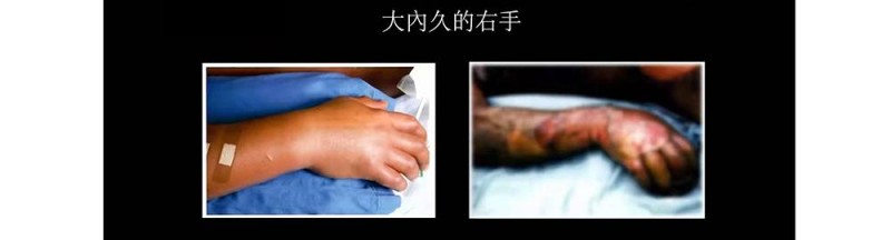 福岛核泄漏后人变异(被核辐射过的人体会变异成什么样)