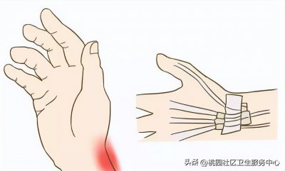 ​当心手腕疼！1个动作自测“腱鞘炎”！6个动作快速摆脱它！