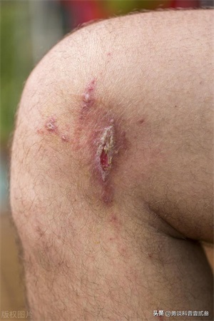 怎么判断是不是被隐翅虫咬了(隐翅虫咬了的初期症状)