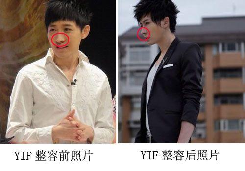 yif整容,整容后遗症,本文共(482字) yif整容,整容后遗症,本文共(482字)