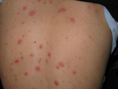 ​上覆糠秕样鳞屑的玫瑰色的斑丘疹，先有母斑，可能是玫瑰糠疹