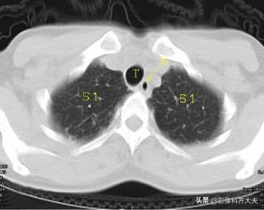 ​肺段支气管解剖